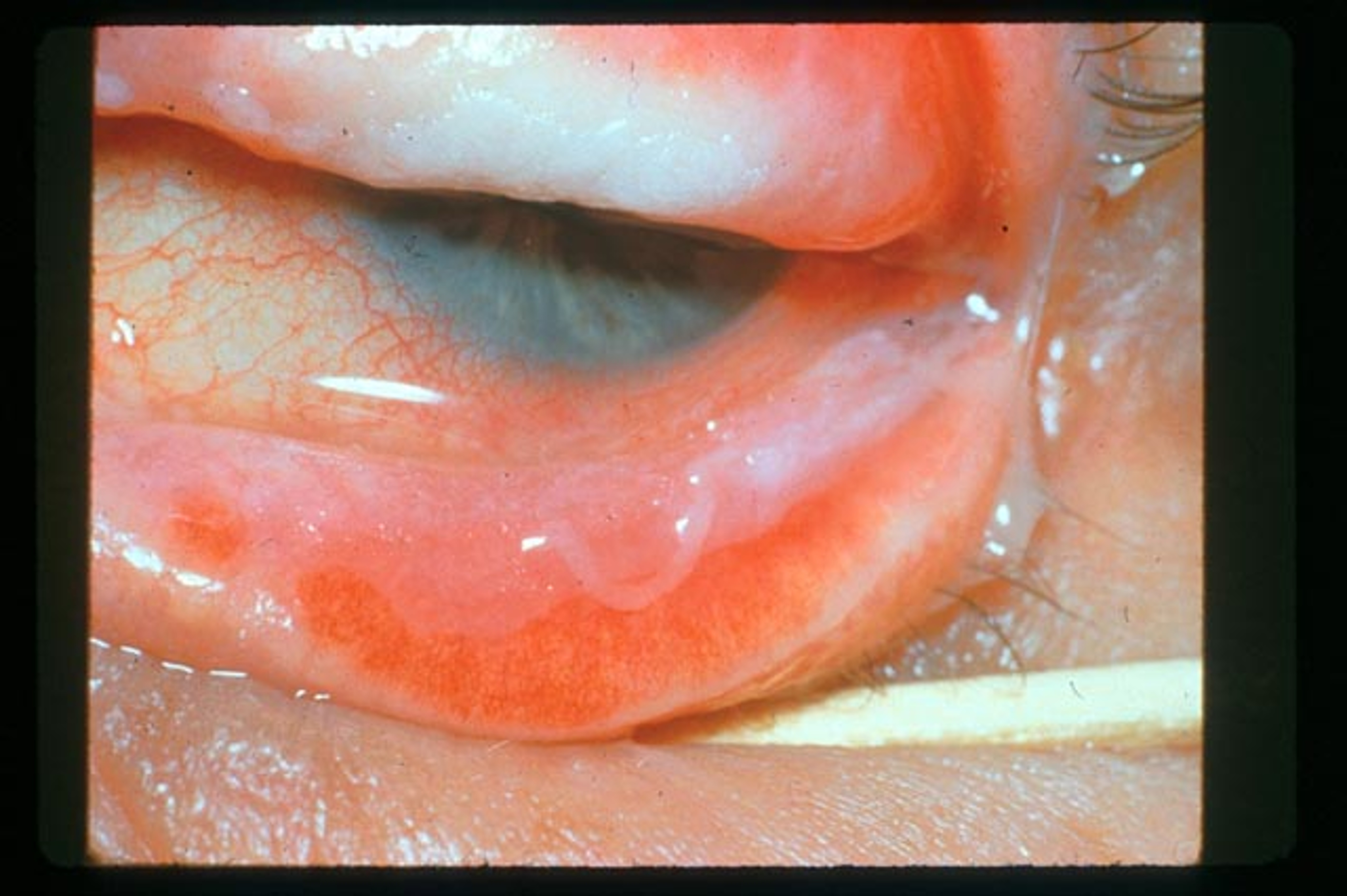 <ul><li><p><span>Disorder of the immune system caused by an adverse reaction <strong>to drugs and viruses</strong> e.g herpes simplex</span></p></li><li><p><span>Hypersensitivity of mucous membranes and skin - <strong>MUCIN DEFICIENCY&nbsp;</strong></span></p></li><li><p><span style="color: blue"><strong>Males </strong>more susceptible (2:1)</span></p></li><li><p><span>Signs of;</span></p><ul><li><p><span>Papillary conjunctivitis</span></p></li><li><p><span>Dry eye&nbsp;</span></p></li><li><p><span>Epiphora following lacrimal drainage obstruction</span></p></li></ul></li></ul><p></p>
