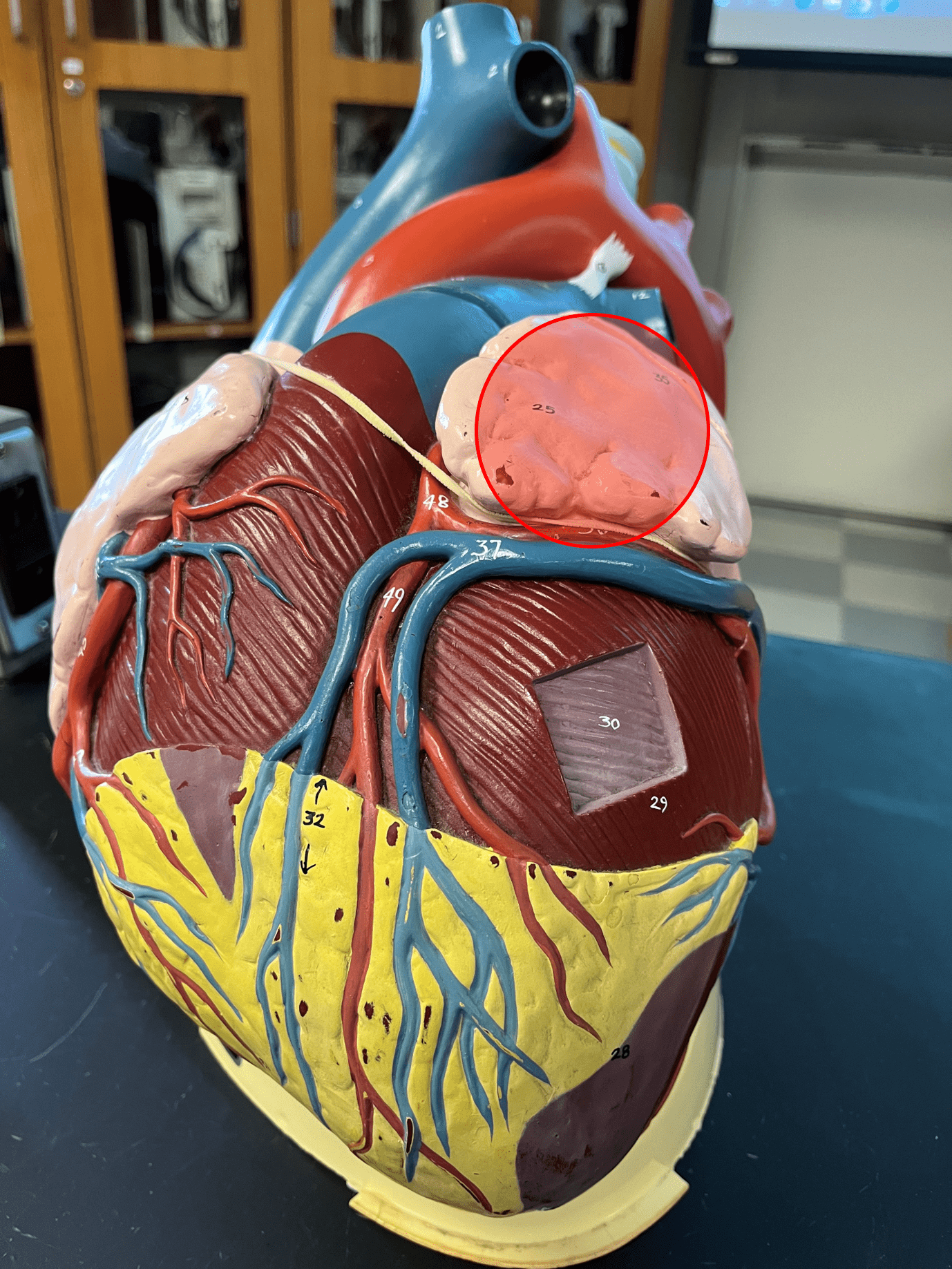 A sac contained within and increasing the volume of the left atrium.