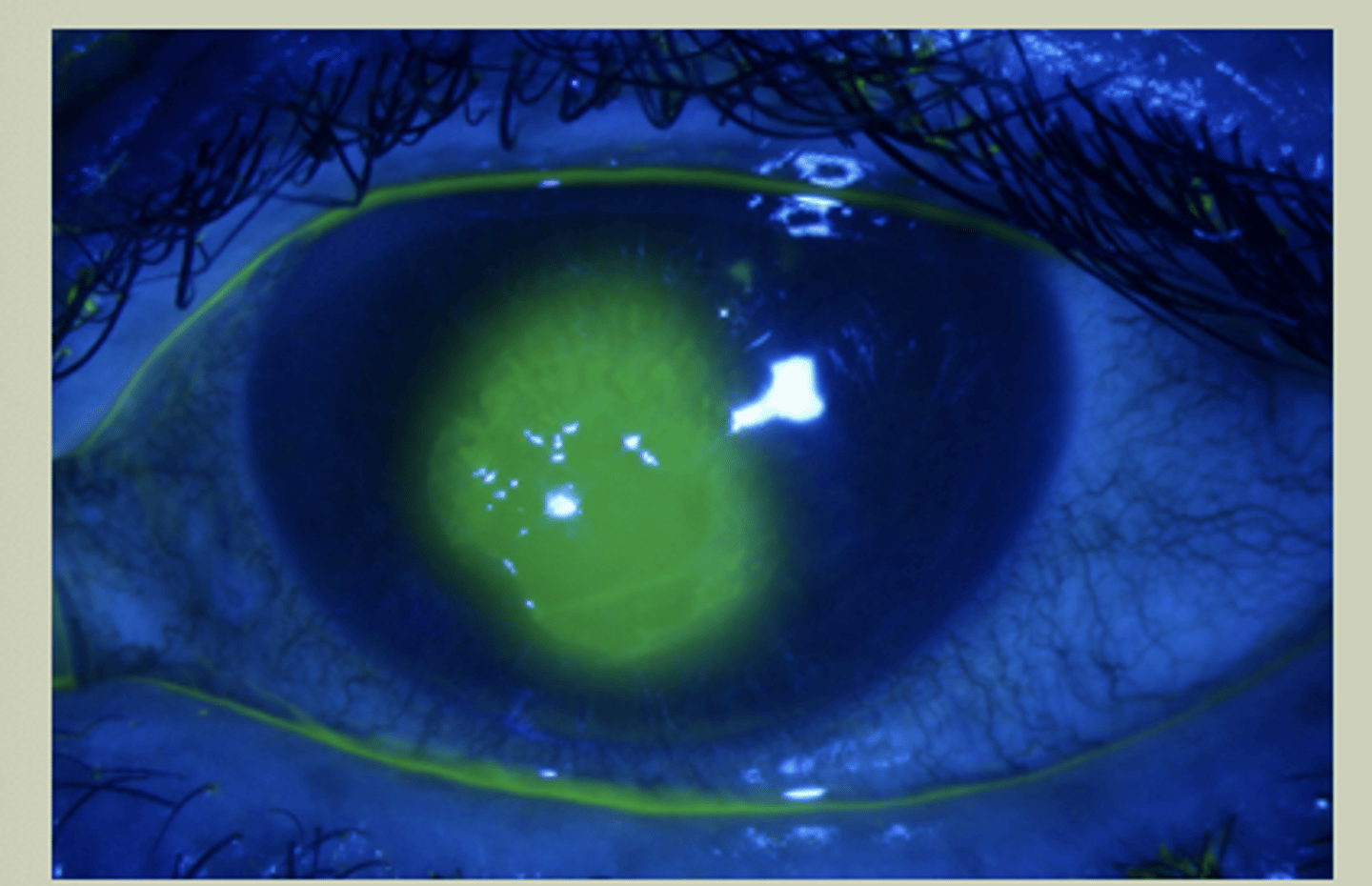 <p>-Will pool in areas of corneal defects</p>