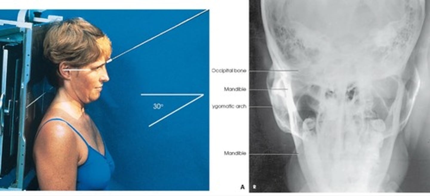 <p>What is this projection?</p><p>How is Patient positing?</p><p>What is the CR?</p><p>What are the structures shown?</p>