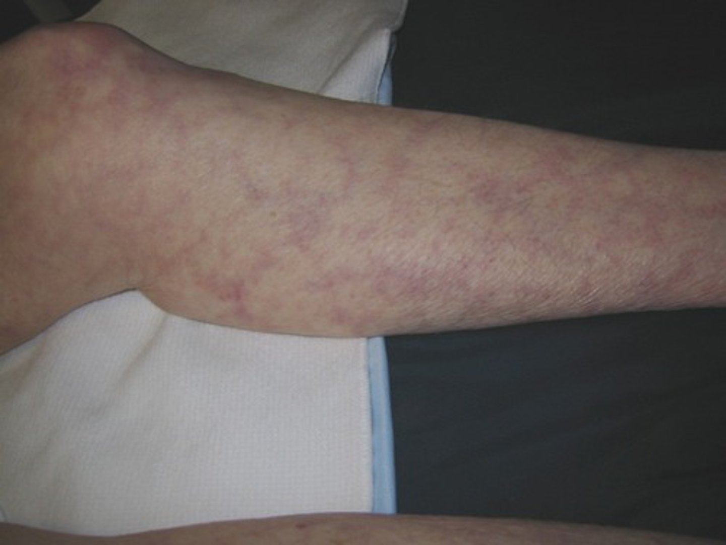 <p>livedo reticularis</p>