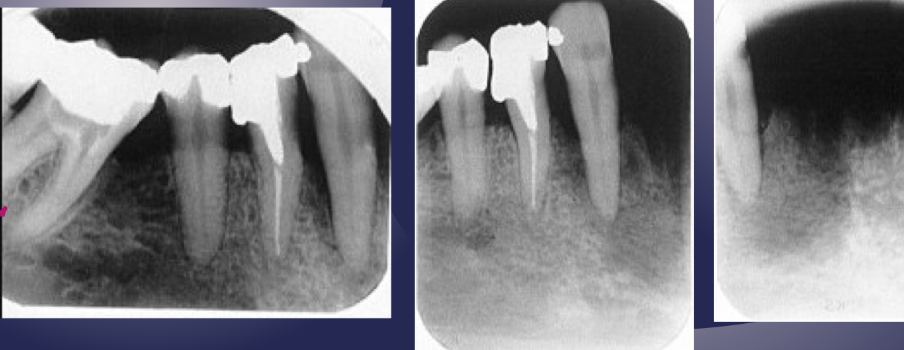 <p>which osteomyelitis phase? </p><p>internal structure:</p><ul><li><p>decrease in bone density, loss of sharpness of trabeculae </p></li><li><p>localized or scattered regions of radiolucency, ill defined periphery </p></li><li><p>mixed radiolucent-radiopaque areas</p><ul><li><p>“moth-eaten”</p></li><li><p>irregular outline</p></li></ul></li></ul><p>help: mandibular trabeculae looks like lasagna but here more granular and indistinct </p>