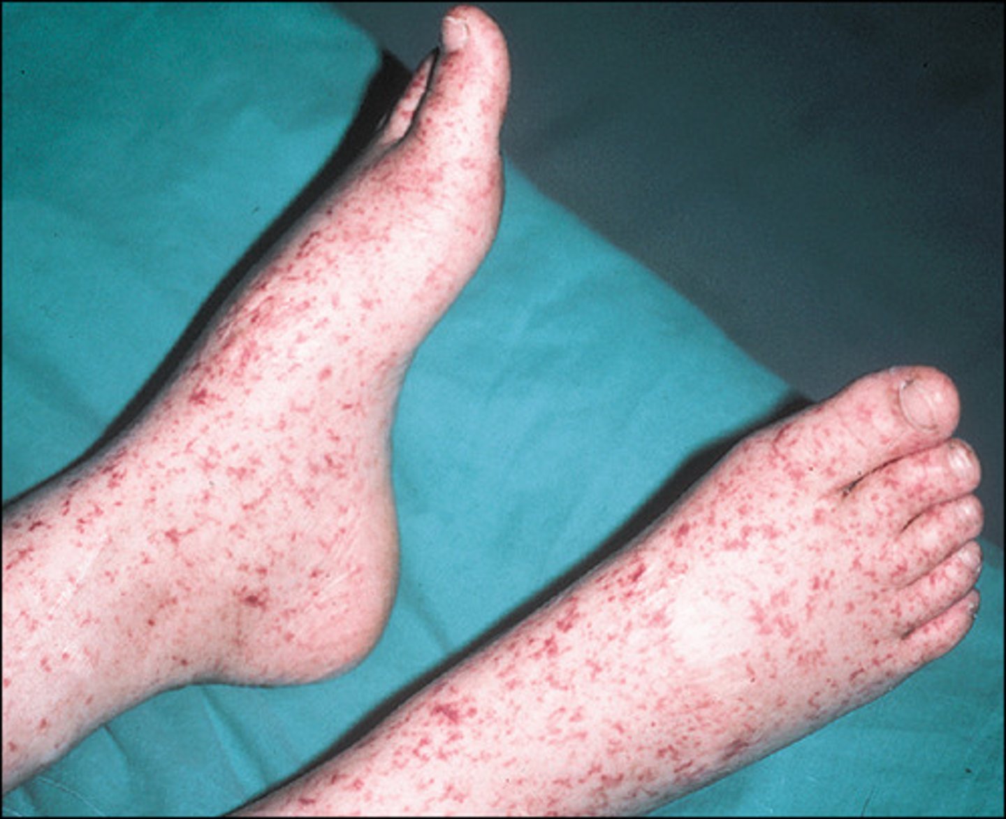 <p>bacteria that is spread by tick bites<br>makes little spotted rash</p>