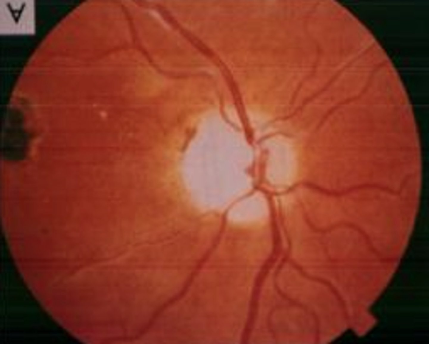 <p>White disc lack vessels</p>