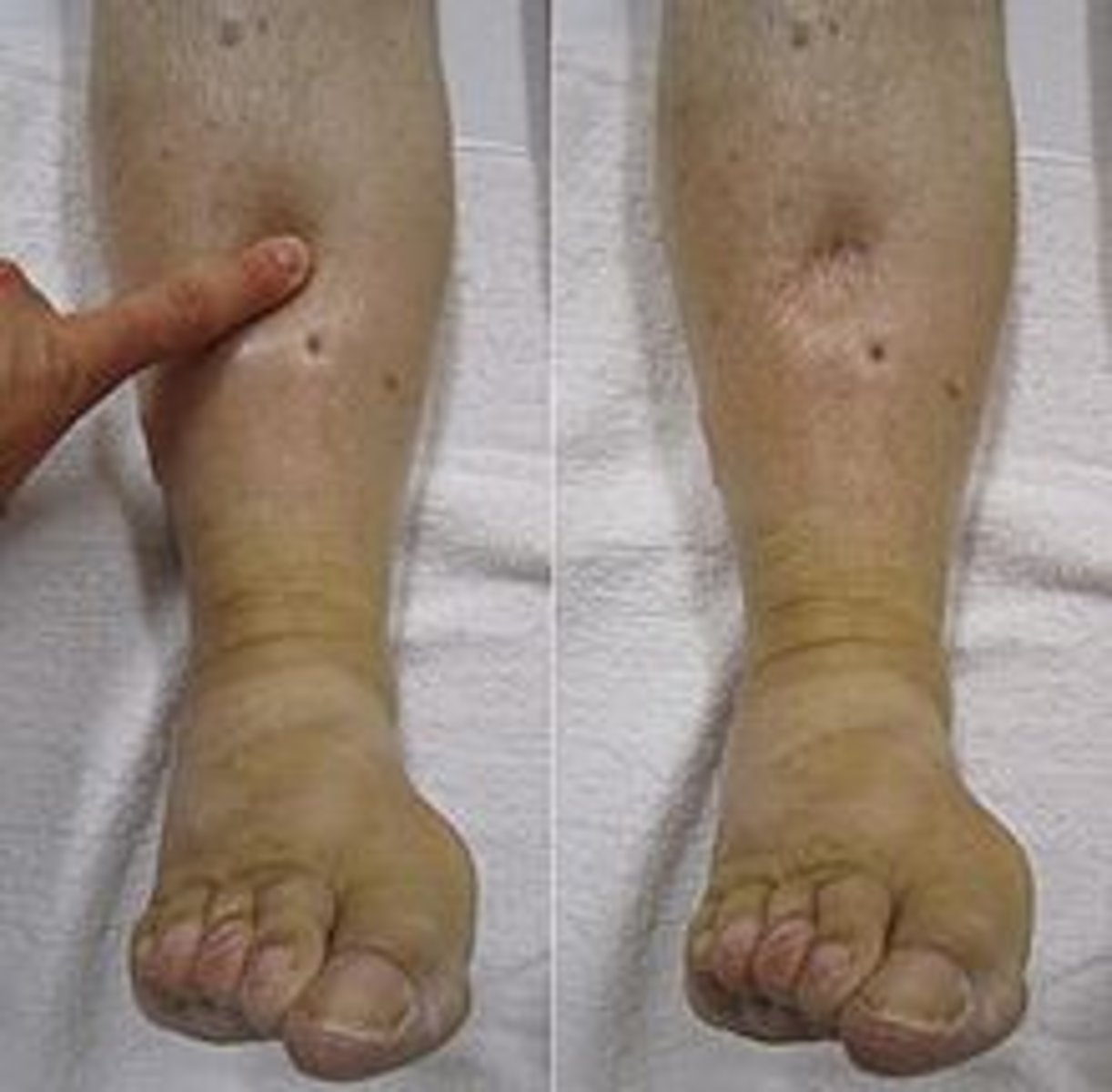 <p>swelling</p>