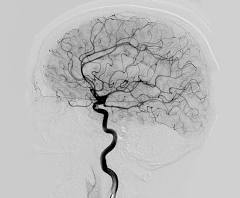 <p><span><span>determines narrowing or blockage of artery in brain; diagnoses aneurysm, tumor, CVA; catheter is used; x rays taken</span></span></p>