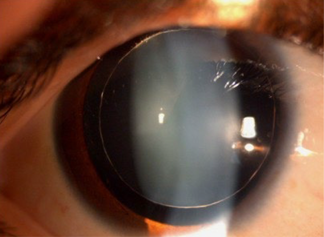 <ul><li><p>small, spherical lens</p></li><li><p><span><span>Systemic condition association: Marfan, congenital rubella</span></span></p></li><li><p><span><strong><span>Presentation</span></strong><span>:</span></span></p><ul><li><p><span><u><span>Refractive error</span></u><span>: high myopia</span></span></p><ul><li><p><span><span>Accommodation dysfunction</span></span></p></li></ul></li><li><p><span><u><span>Lens</span></u><span>: thick crystalline lens with small diameter</span></span></p><ul><li><p><span><span>Entire equatorial margin will be seen with dilation</span></span></p></li><li><p><span><span>Movement of lens with change in posture</span></span></p></li><li><p><span><span>ectopia lentis</span></span></p></li></ul></li></ul></li><li><p><span><strong><span>Complications</span></strong><span>: glaucoma (51%)</span></span></p><ul><li><p>d/t pupillary block, angle blockage, or angle abnormalities</p></li></ul></li><li><p><strong>Treatment</strong>:</p><ul><li><p><span><span>Surgical management: lens extraction</span></span></p></li><li><p><span><span>Surgical management of glaucoma</span></span></p></li></ul></li></ul><p></p>