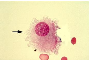 <p>A CSF sample was cytocentrifuged and the smear was stained. Which is true about the cell in the image?</p><p>Increased numbers of this cell is seen in patients with bacterial meningitis </p><p>It lines the arachnoid space (CNS)</p><p>It is a monocyte</p><p>It is a malignant cell</p>