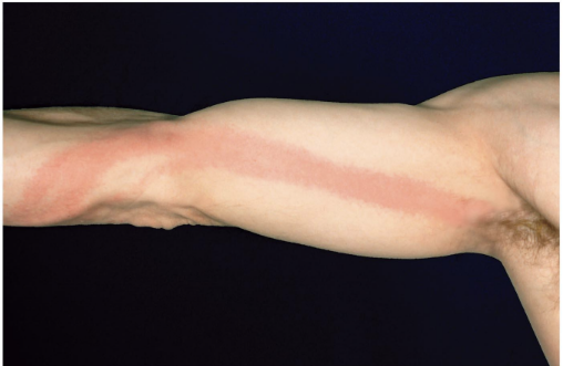 <p>Inflammation of lymph vessels associated with septicemia and septic shock.</p>