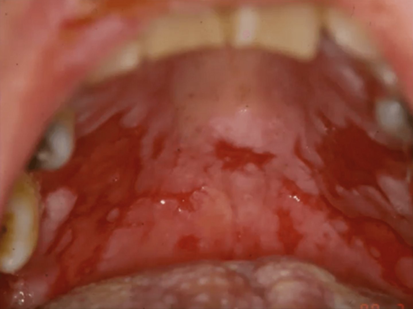<p>A presents with painful oral ulcers and sloughing of the mucosa when slight pressure is applied. What is the MOST likely diagnosis?</p>