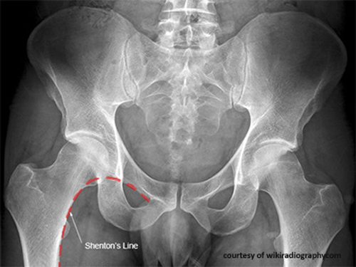 <p>What is Shenton’s Line used for?</p>