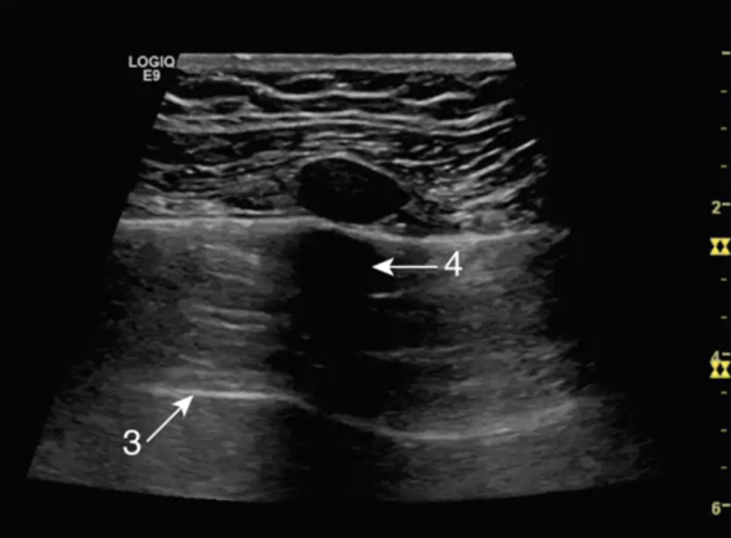 <p>what artifact is demonstrated by arrow 3?</p>