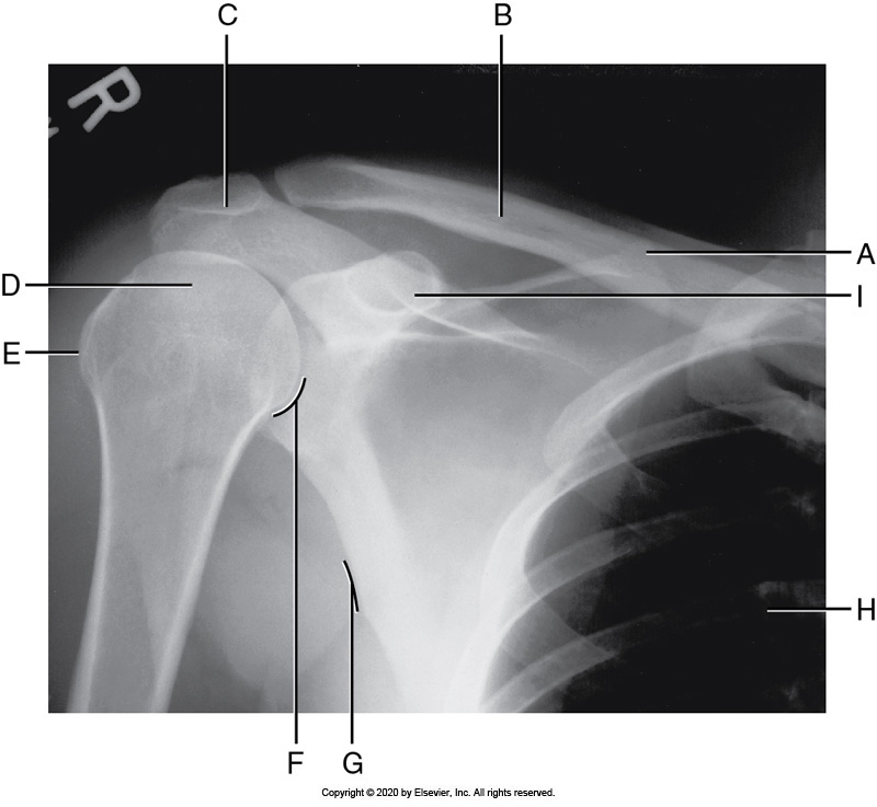 <p>Identify the labeled "I" anatomy in the image below:</p><p>Greater tubercle</p><p></p><p>Coracoid process</p><p>&nbsp;</p><p>Humeral head</p><p>&nbsp;</p><p>Acromion process</p>