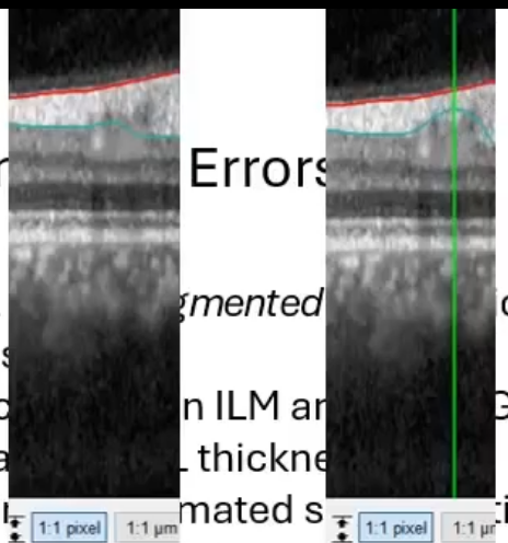 <p>retinal layers segmented automatically by device software </p><p>distance between ILM an RNFL/GCL boundary = RNFL thickness </p><p>sometimes automated segmentation chooses the wrong reflectance change eg a shadow </p><p>results in incorrect measurements but can be manually corrected by drawing on where you wnat it  </p>