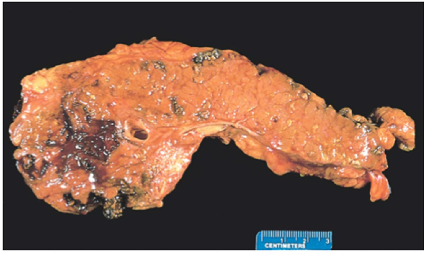 <p>Acute pancreatitis is characterized by:</p>