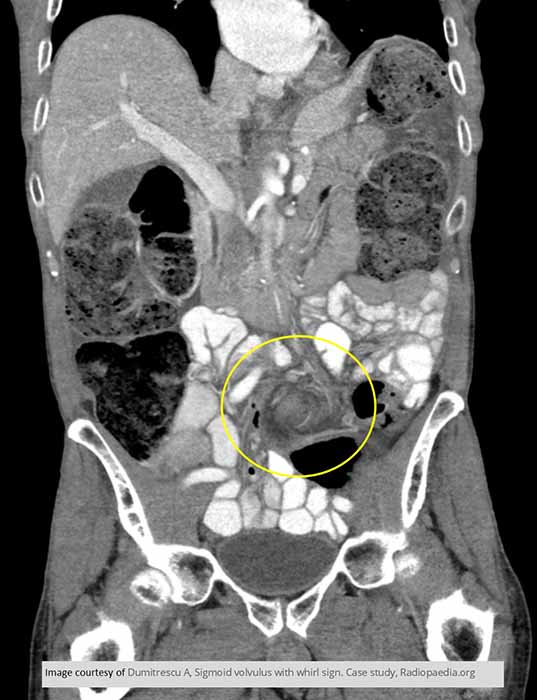 <p>What are the two major dangers of volvulus?</p>