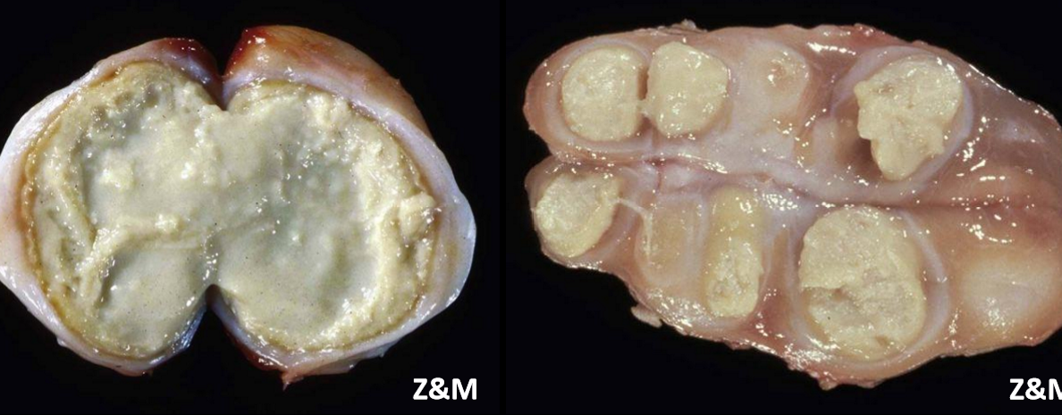 <p>What is this and its pathogenesis</p>