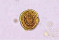 <p>Name this crystal? what is it associated with (3 things)? what is its ph? normal or abnormal?</p>