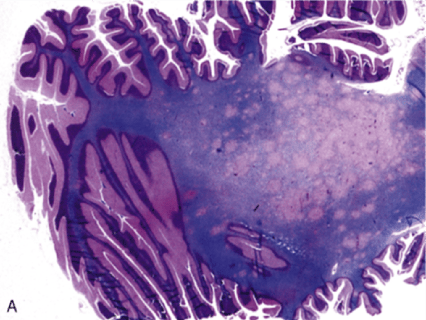 <p>Define Virus:</p><p>Viral Infection of meninges</p><p>Info:</p><p>-Due to JC polyomavirus; Possible reactivation of latent virus (esp if immunocompromised)</p><p>-Infects oligodendrocytes =&gt; demyelination</p><p>-Sx: dementia, weakness, visual loss, and ataxia</p><p>-FATAL</p>