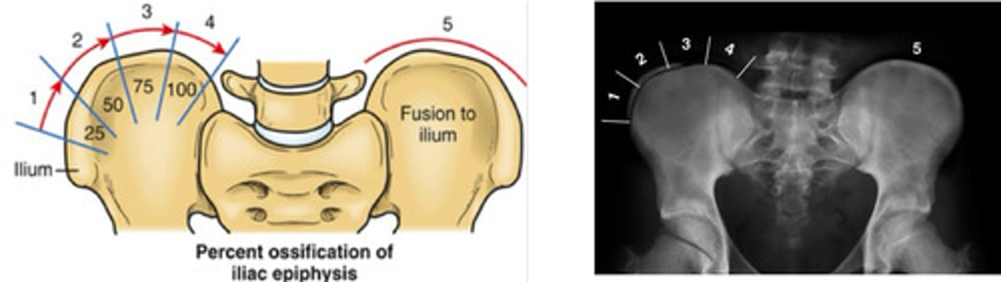 <p>how much mature bone has developed on the top part of the iliac apophysis (growth plate on iliac crest)</p>