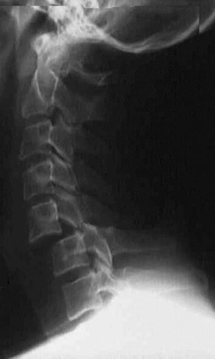 <p>what is the most likely mechanism of injury</p>