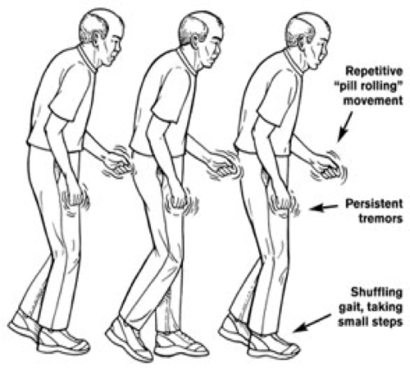 <p>Shuffling gait</p><p>stiff manner</p><p>stooped over</p>