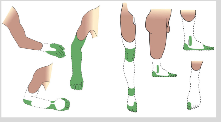<p><span>•	Nociceptor-driven pain: arises from ongoing peripheral tissue damage.</span></p><p class="p1"></p><p class="p1"><span>•	Centrally maintained pain: occurs without peripheral injury; includes phantom limb pain and central pain syndromes (e.g., post-stroke).</span></p>