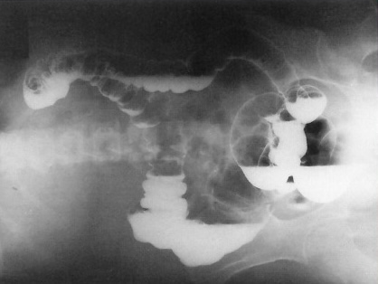 <p>What is this x-ray demonstrating?</p>