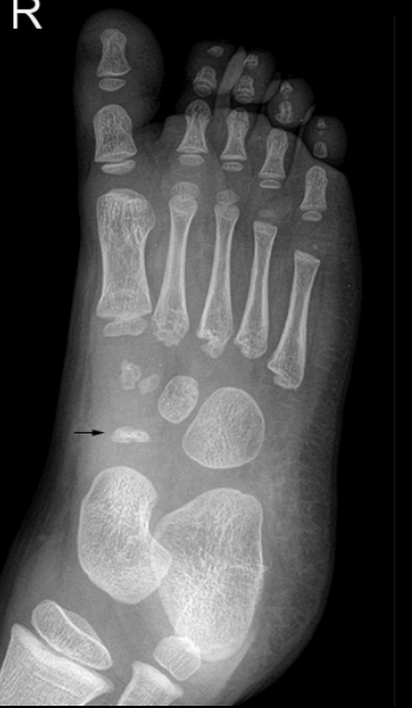<p>Radiographic findings in Köhler’s disease?</p>