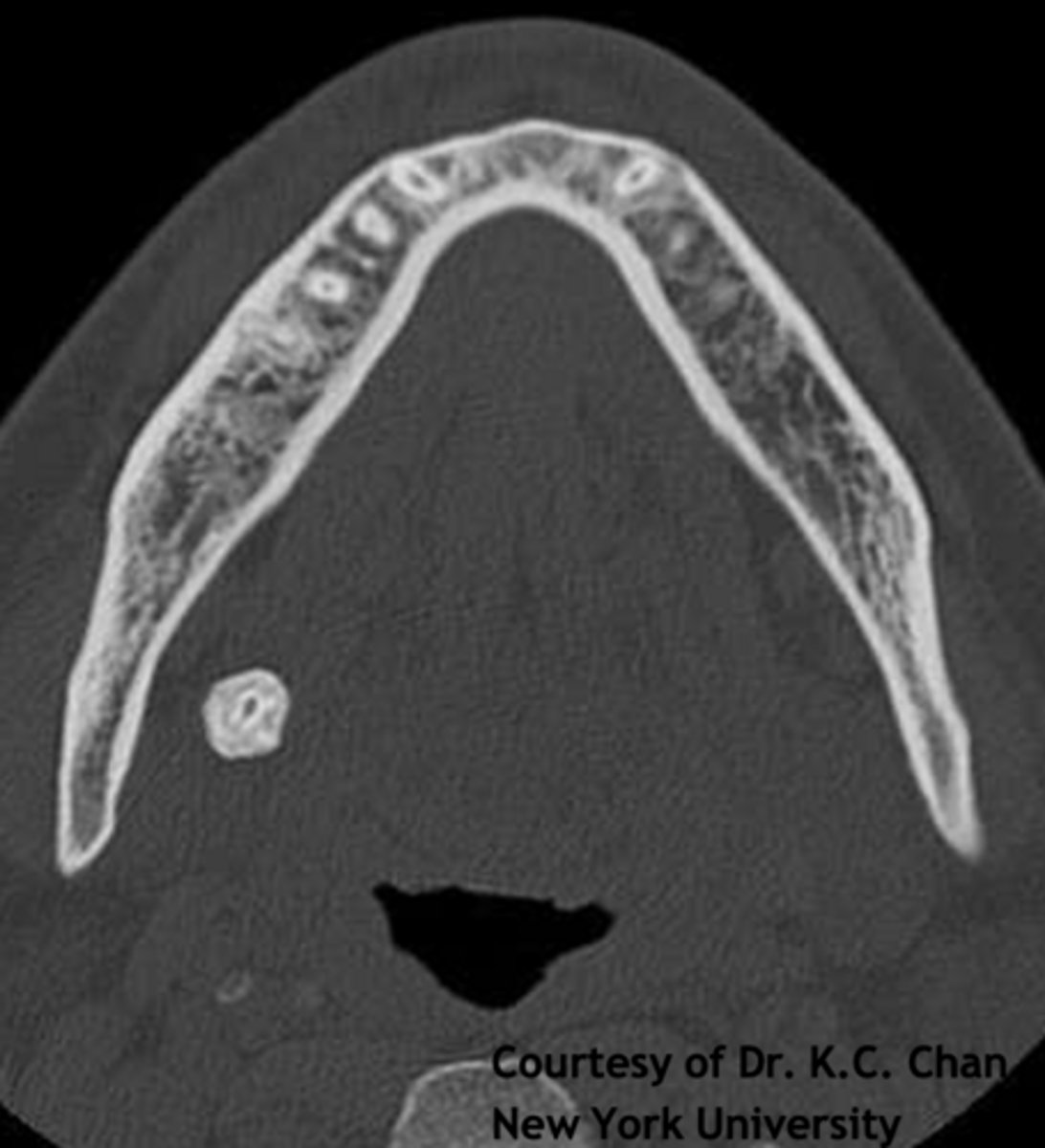<p>ID the pathology:</p>