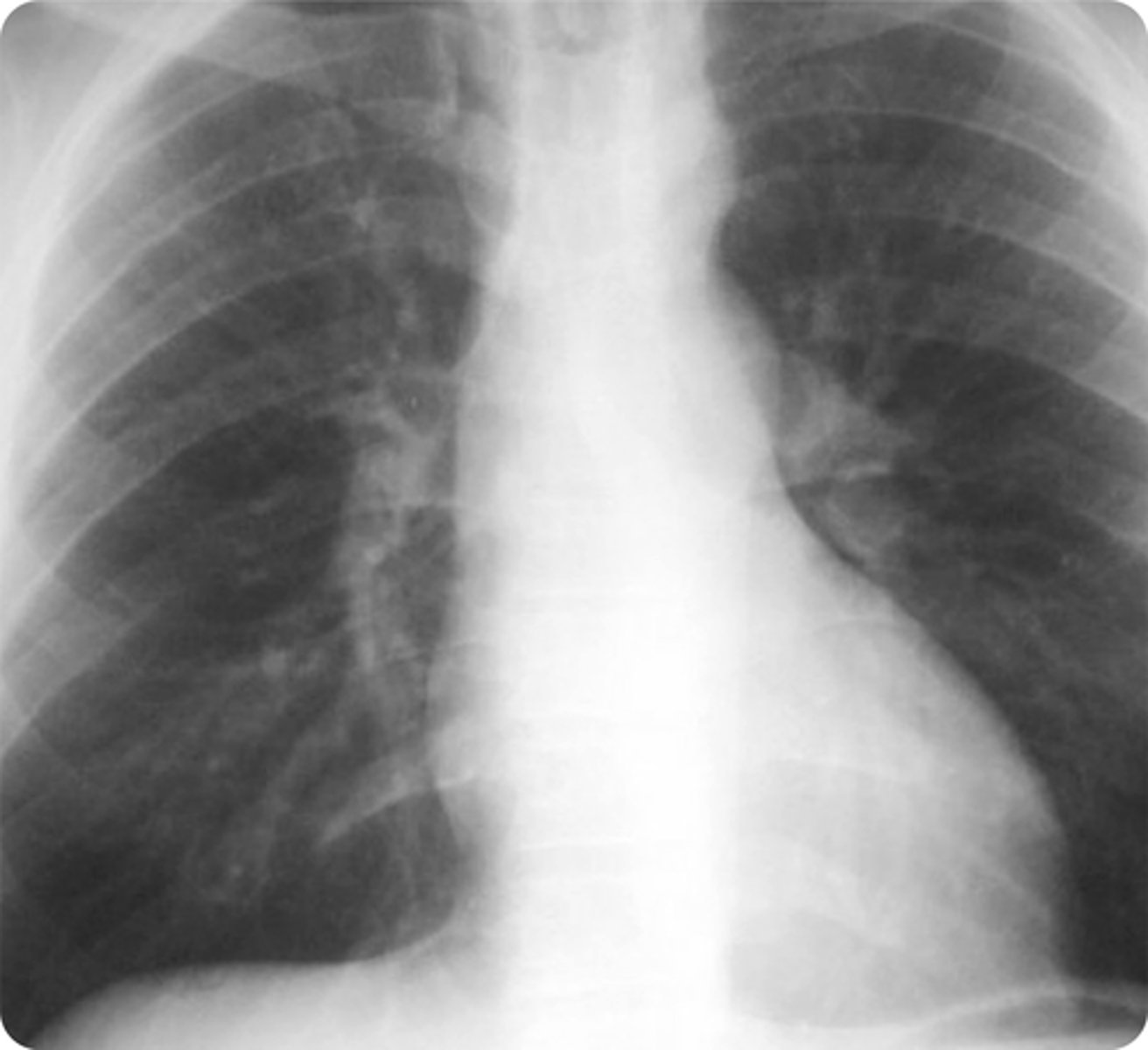 <p>A 14-year-old boy without significant medical history presents with his parent to clinic with concern for cold extremities, pain in his legs with exercise, and intermittent chest pain for the past month. Vital signs today include a heart rate of 66 bpm, respiratory rate of 18/min, oxygen saturation of 97%, and temperature of 98.8°F. Chest X-ray is shown above. Which physical exam finding is most likely to be present in the patient’s suspected condition?</p><p>ADelayed femoral pulse when compared to the brachial pulse</p><p>BEpisodic hypercyanotic spells</p><p>CMidsystolic ejection murmur with a fixed split S2 heart sound</p><p>DRespiratory stridor</p>