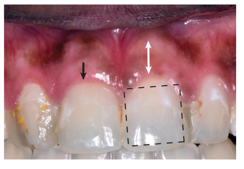 <ol><li><p>Wide, square-shaped crown</p></li><li><p>Thick, dense fibrotic tissue</p></li><li><p>Wide band of keratinized tissue</p></li><li><p>Flat gingival margin contour </p></li><li><p>Less pronounced tissue scalloping</p></li><li><p>Large interproximal contact areas </p></li><li><p>Thick alveolar bone </p></li></ol><p><em>**more resilient and less susceptible to inflammation and trauma than thin/thick scalloped biotypes. </em></p><p></p>