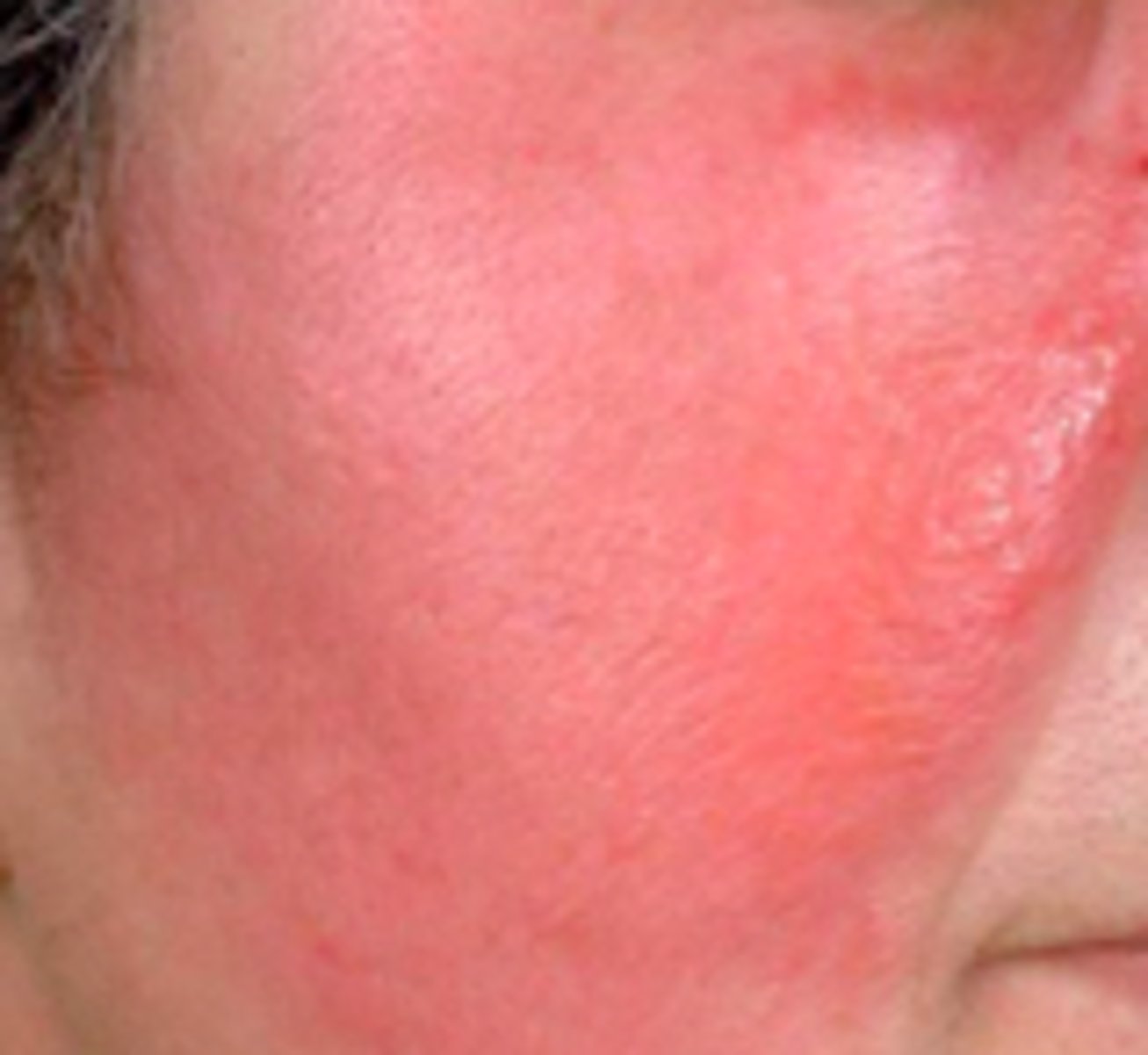 <p>Bacterial ID:</p><p>Overview:</p><p>- Skin infection involving the dermis layer of the skin (can extend → superficial cutaneous lymphatics)</p><p>- Group A beta-hemolytic streptococci</p><p>- More common in females but occurs in all age groups (common in extremes of age)</p><p>- Distinguishing characteristic between this and cellulitis: this is very well-demarcated (clear to tell where it starts/ends)</p>