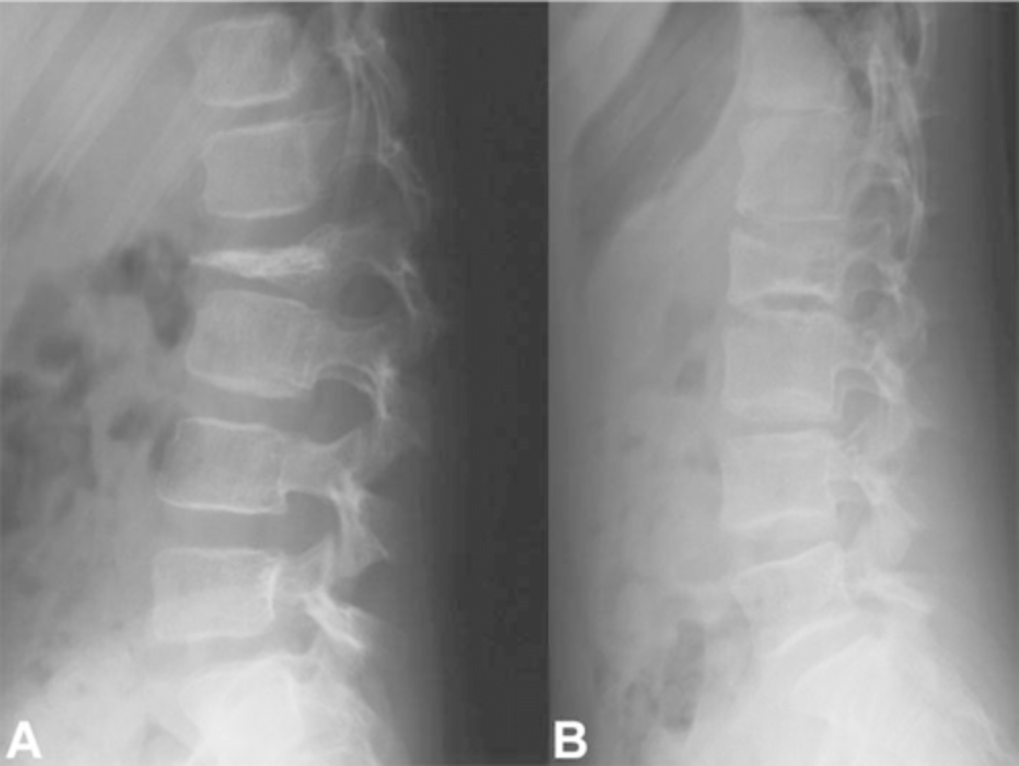 <p>ID benign tumor</p>