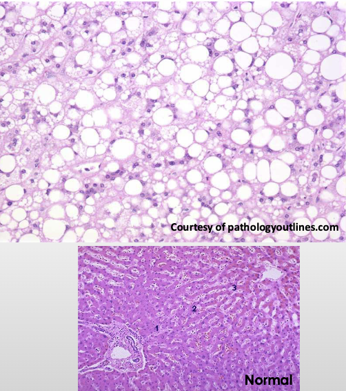 <ul><li><p>alcohol abuse</p></li><li><p>obesity</p></li></ul><p>(can <span>affect many organs, but commonly the liver)</span></p>