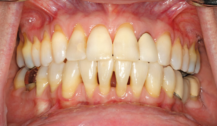 <p>Lack of Attached Gingiva</p>
