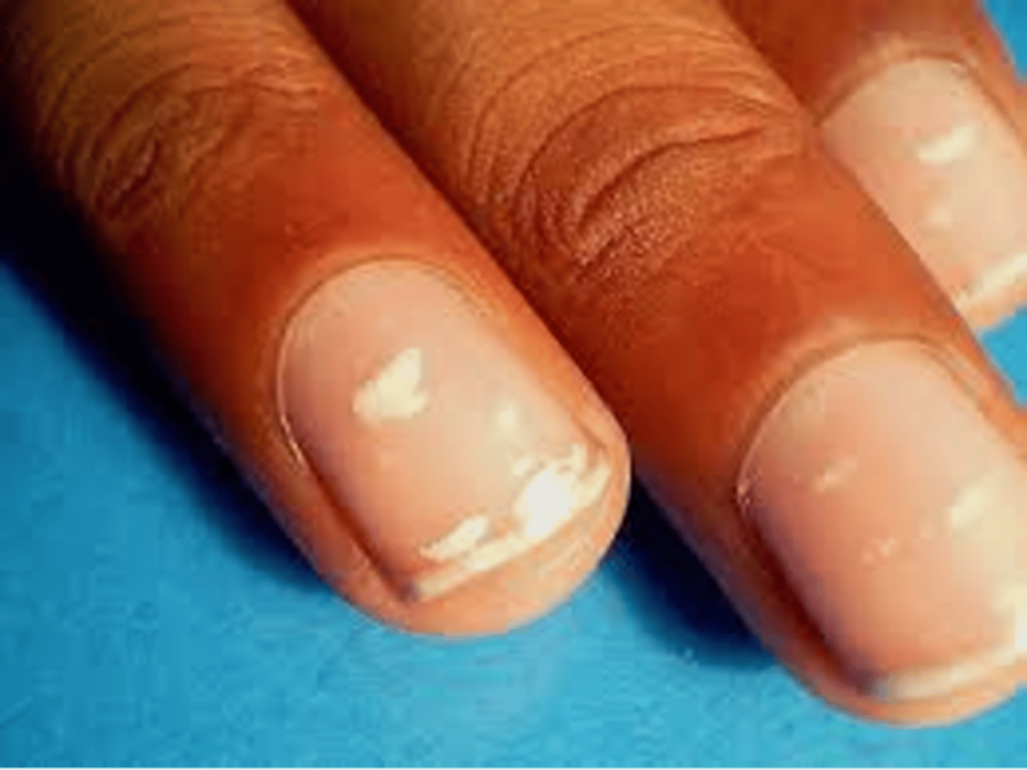 <p>◦White color changes of the nail</p><p>◦Partial or complete</p>