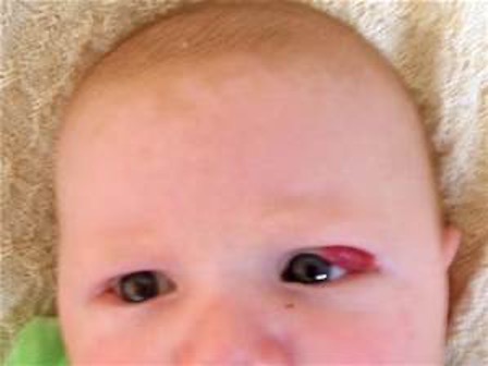 <p><strong>What skin condition is thought to be related to a abnormal growth of blood vessels during fetal development?</strong></p>