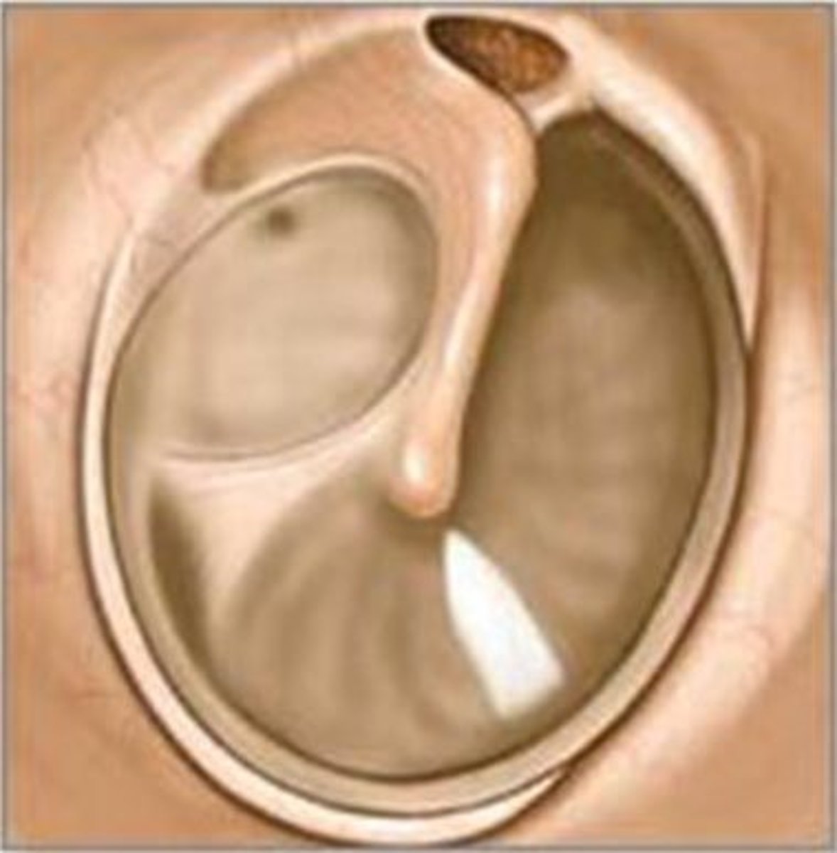 <p>reflection of light from otoscope. means a healthy eardrum</p>