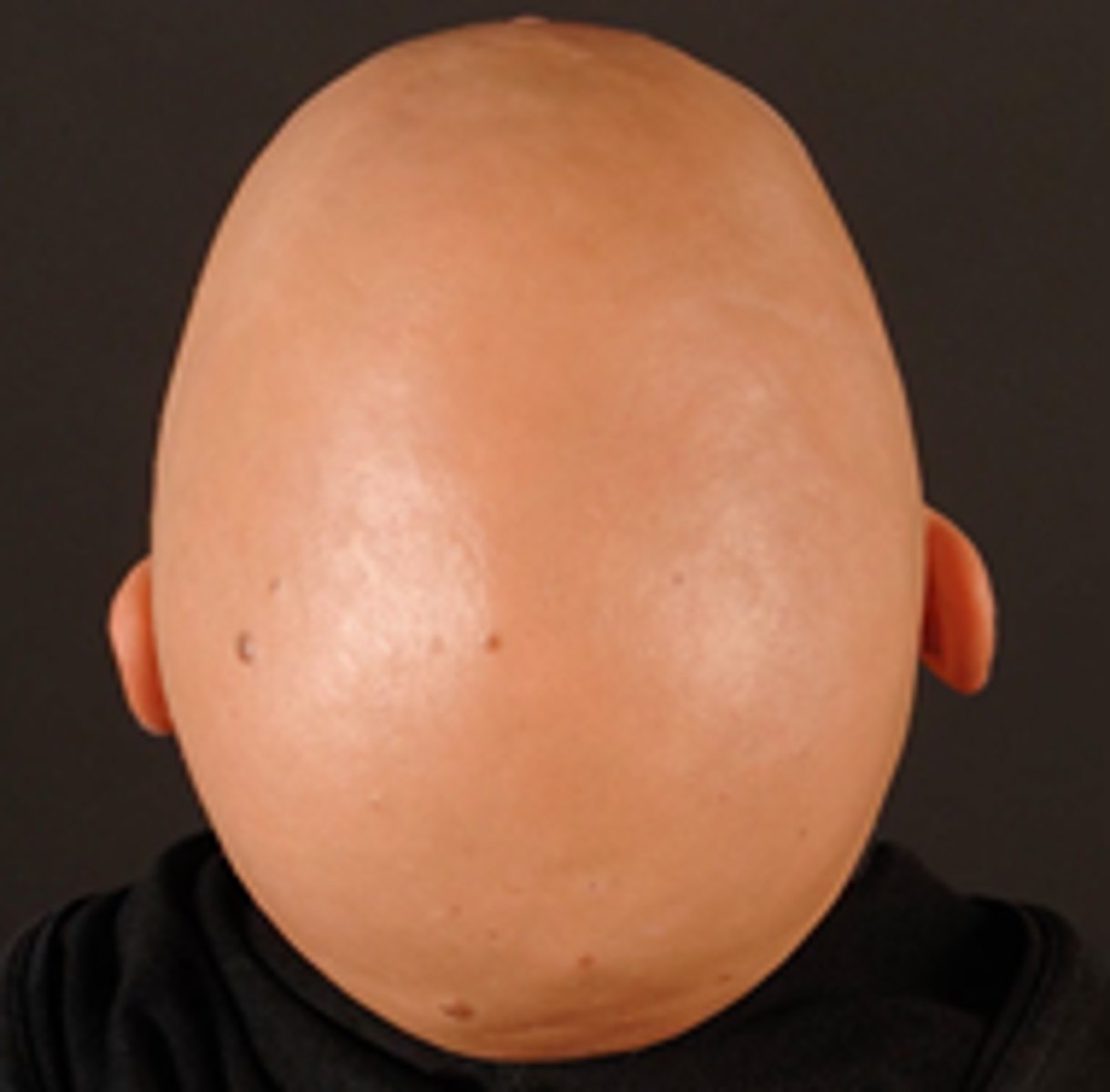 <p>= subtype van alopecia areata waarbij de hele hoofdhuid is aangetast</p>