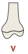 <p>Crushing fracture, prematurely closing the physis</p>