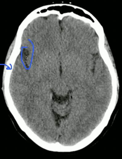 <p>What Sulcus is&nbsp;the circle + What Lobe is the arrow </p>