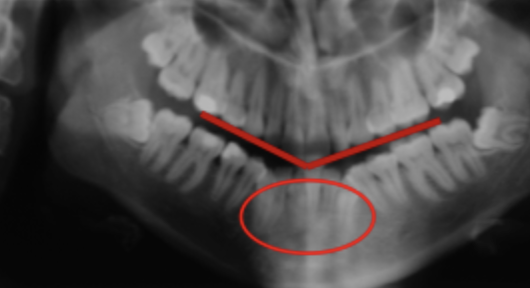 <p>Patient position - Vertical error 1</p>
