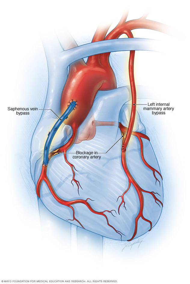 <p>-treat atherosclerosis of coronary vessel blockage</p><p>-blockage is <u>not </u>cleared, instead a detour is created for blood to travel instead</p><p>-use mammary artery, radial artery, or saphenous vein for bypass</p><p>-not a permanent solution</p>