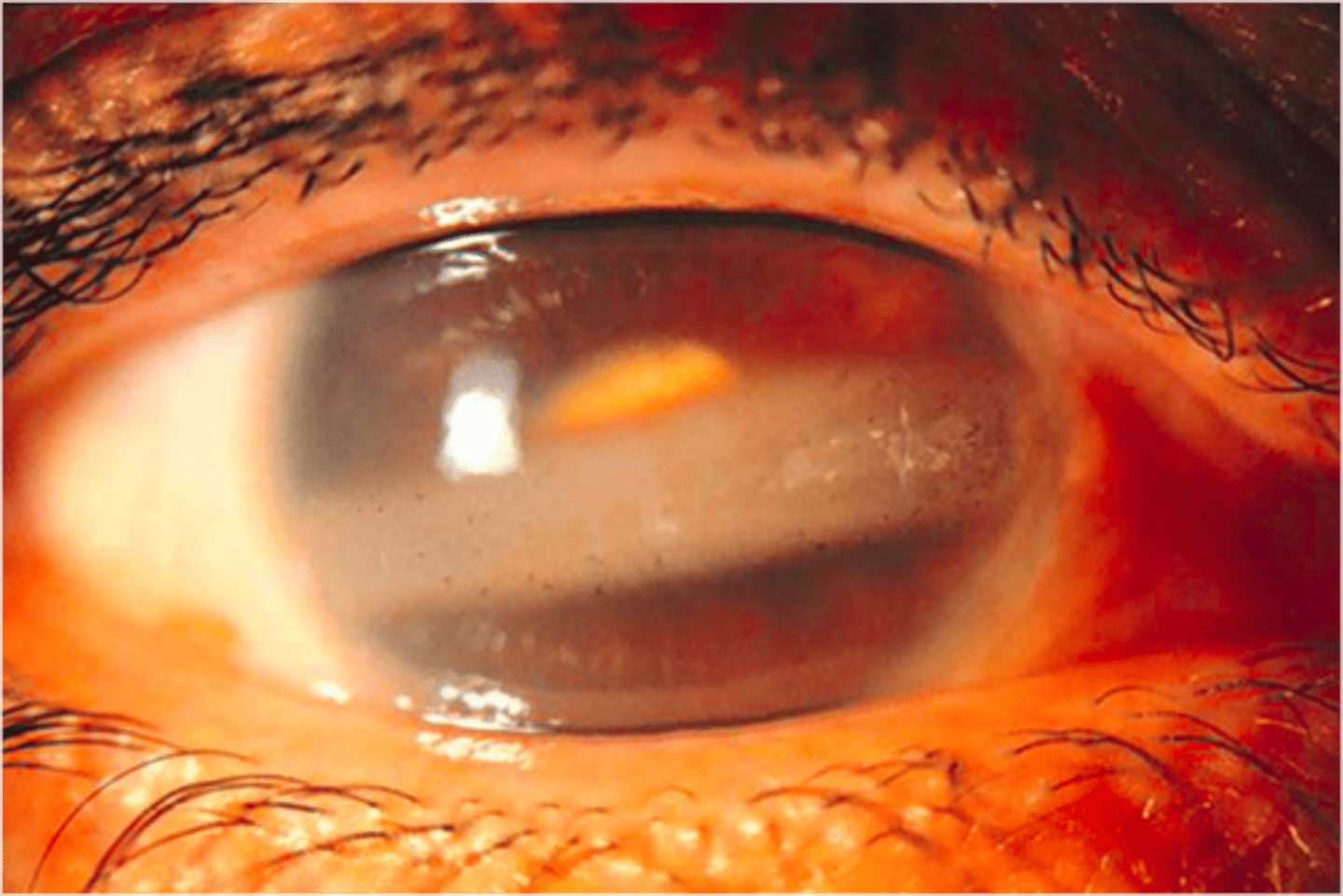 <p>deposition of calcium in the superficial cornea, associated with hyperparathyroidism</p>