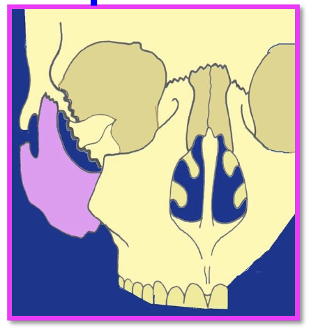 <p>Fracture of zygoma away from the face. Three point fracture. </p>