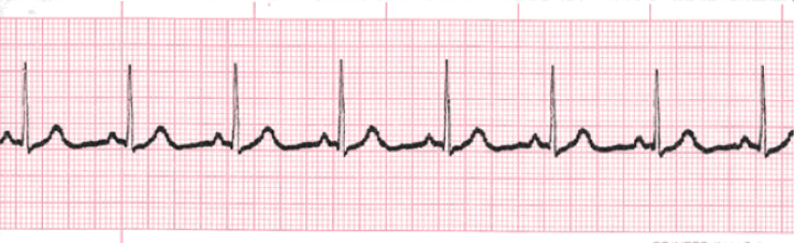 <p>What does this EKG show?</p>