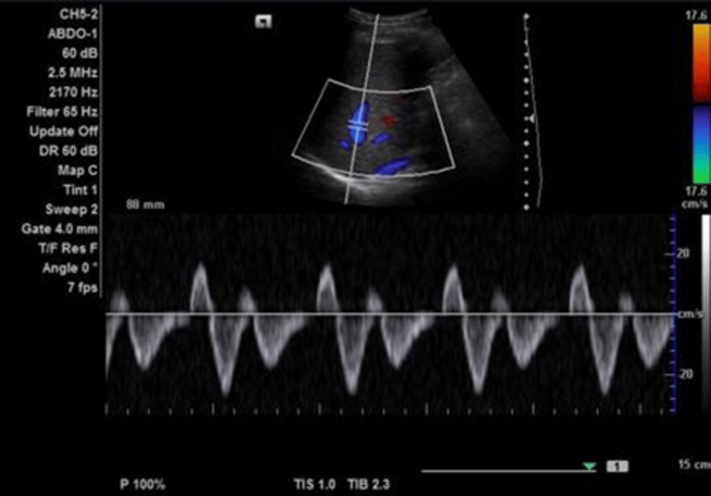 <p>Triphasic</p><p>Antegrade &amp; retrograde flow - cardiac pressure changes</p>