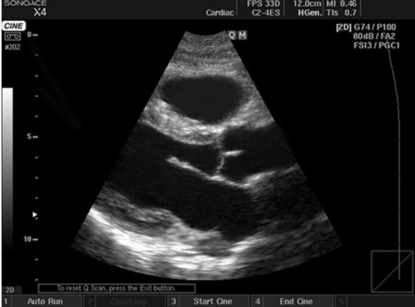 <p>used To assess ascending aorta</p><p>Probe is positioned one or two intercostal space higher than the standard PLAX position</p><p>Aim is to demonstrate the aortic root and long axis of ascending aorta</p>