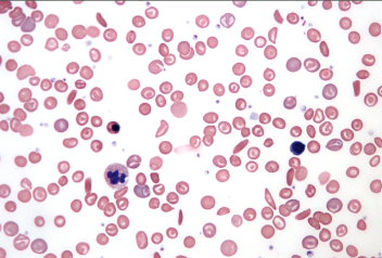 <p><span>Irregularly shaped blood cells that are deoxygenated and tend to stick together and are unable to move through the blood. They can block vessels and prevent movement of oxygenated cells.</span></p>